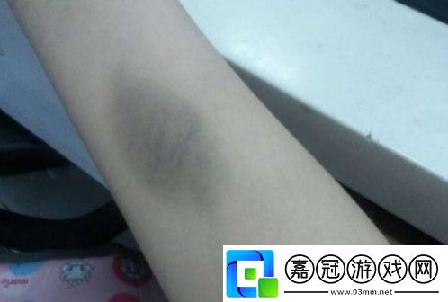 為什么遭到磕碰后皮膚上會出現烏青塊